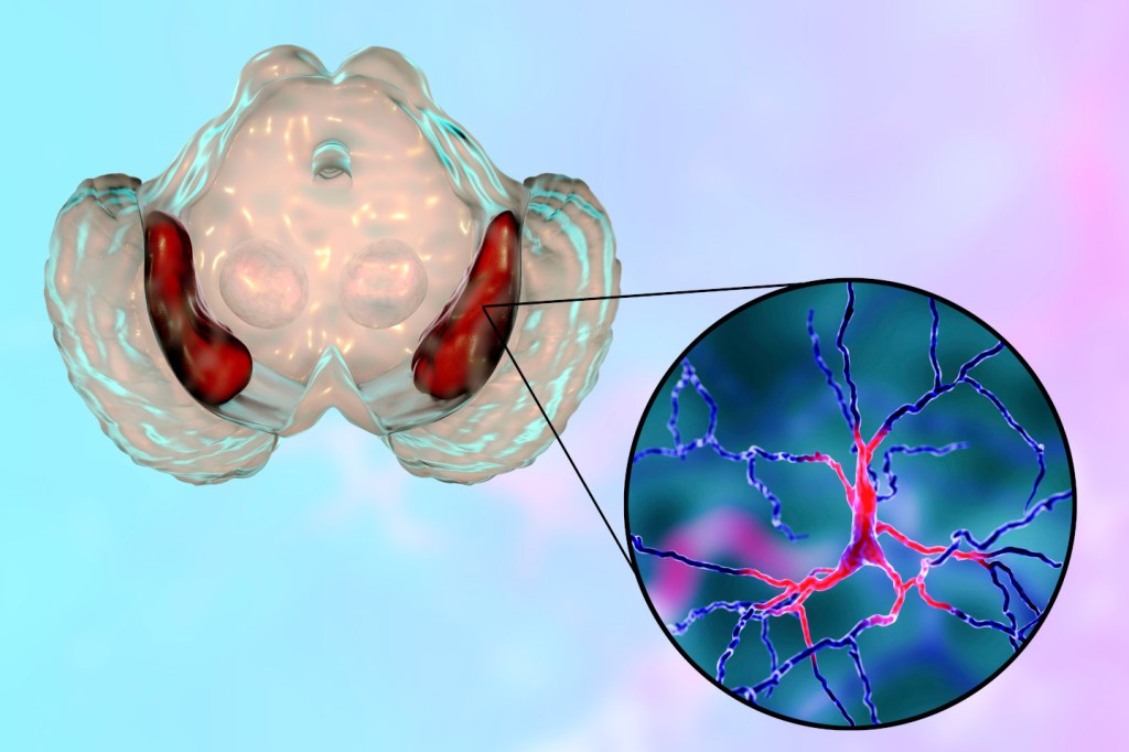 What are the symptoms of MSA to look for?